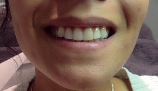 Gummy Smile after Botox Treatment